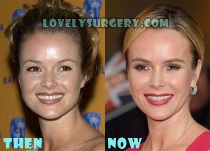 Amanda Holden Plastic Surgery