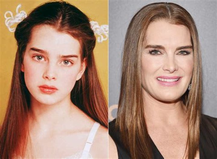 Brooke Shields Plastic Surgery Before and After