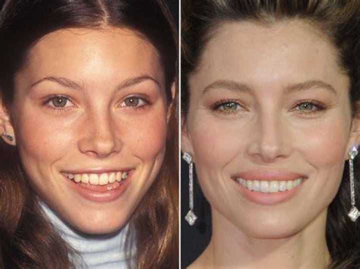 Jessica Biel Plastic Surgery Before and After