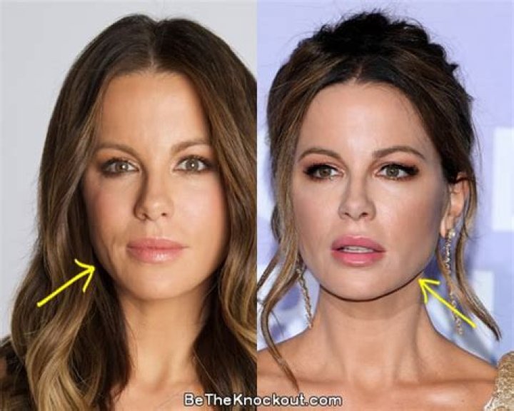 Kate Beckinsale Plastic Surgery Before and After