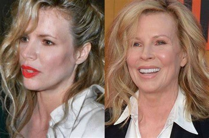 Kim Basinger Plastic Surgery Before and After