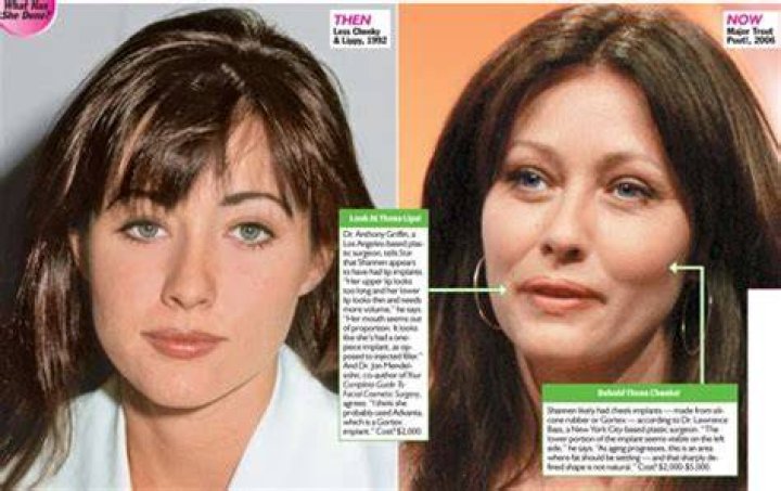 Shannen Doherty Plastic Surgery Before and After